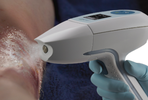 2nd UltraMIST therapy in use