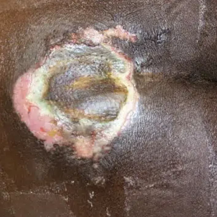 Pressure injury care