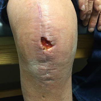 Non-healing surgical wound care