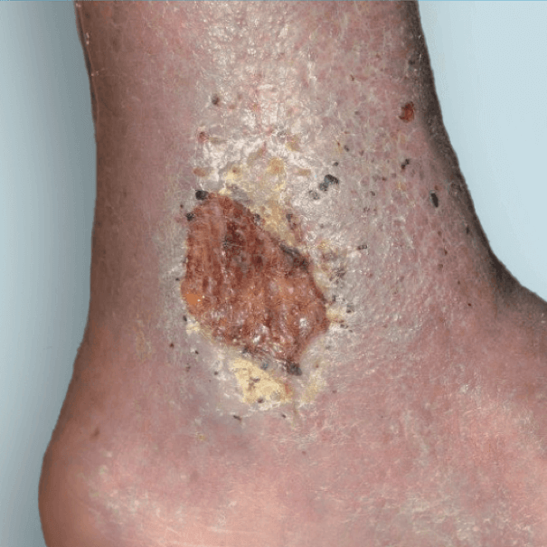 Venous foot ulcer care